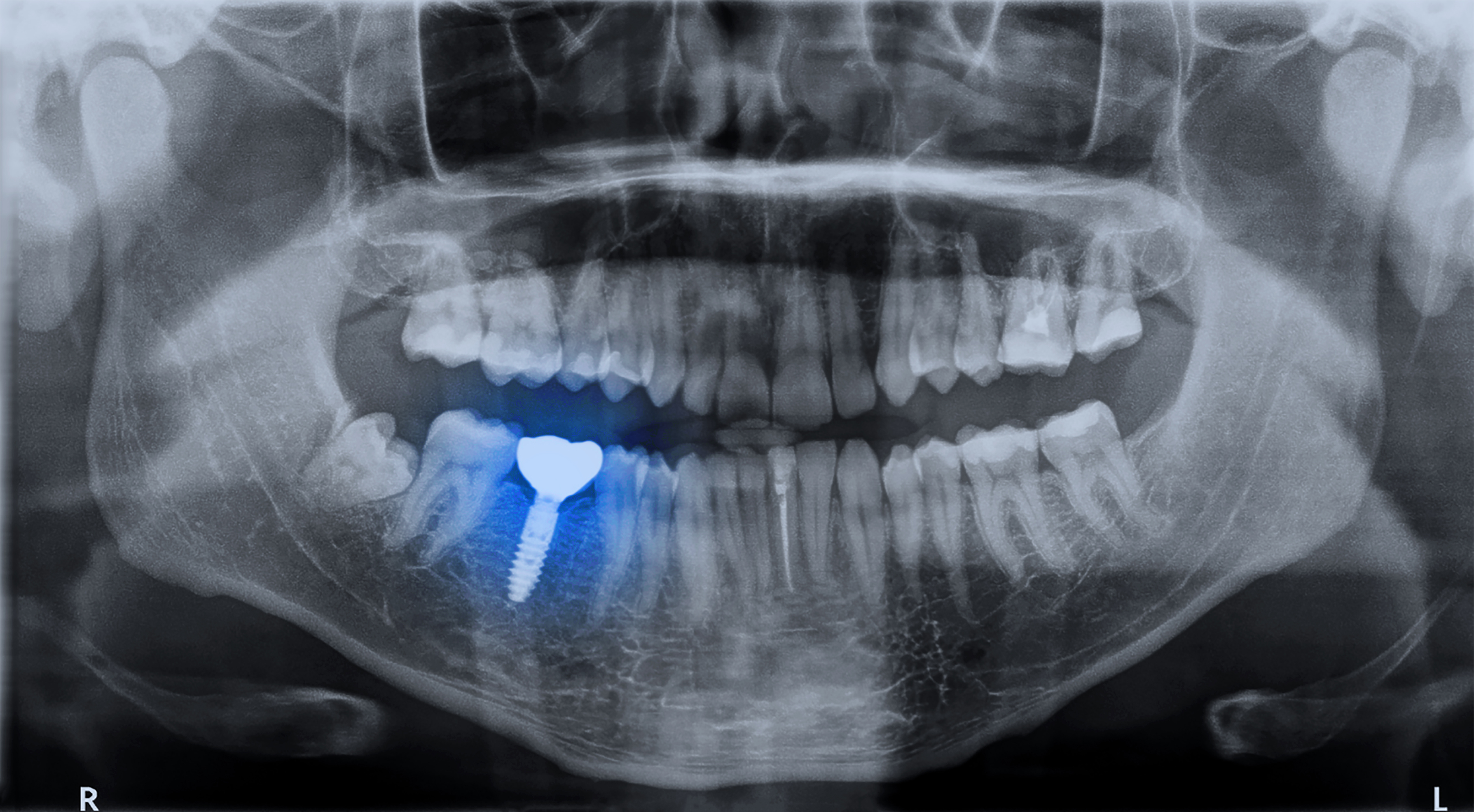 Implante dentário
